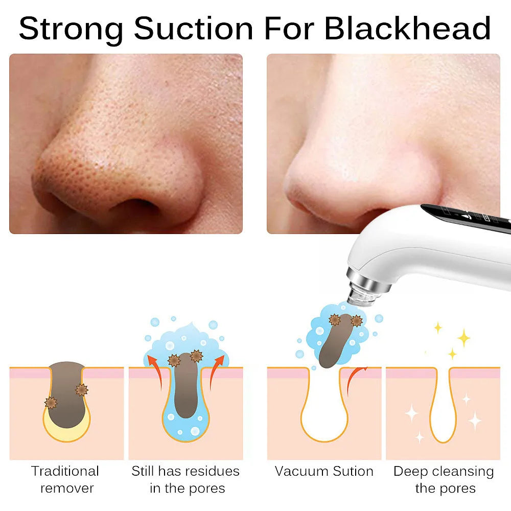 Blackhead Removal Pore Vacuum